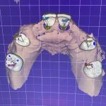 Титановая балка на 6-имплантатах, циркониевый мост